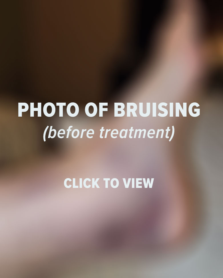 Bruising