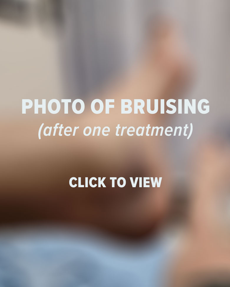 Bruising after